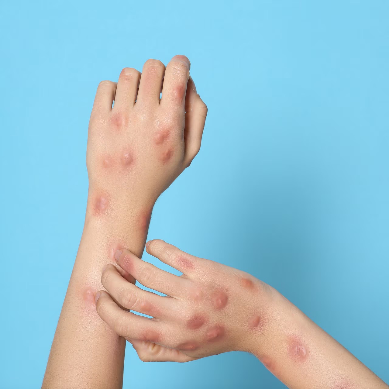 Mpox smitter mange!!